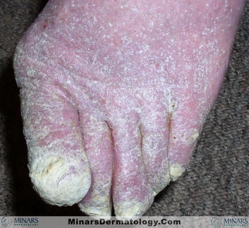 Norweigian Scabies 1A