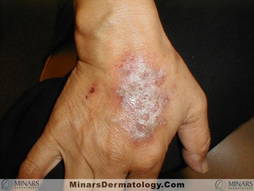 Nummular Eczema A