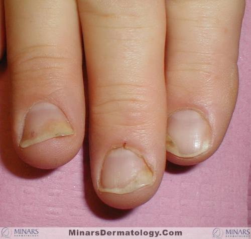 Psoriatic nails 01 c